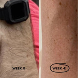 Permanent Hair Remover